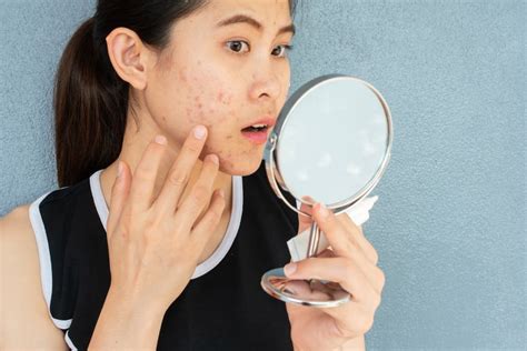 Pantanggal ng Peklat ng Pimples: Anong Skin Care .